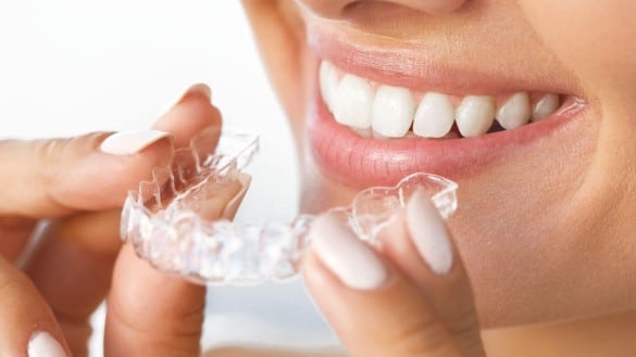 Способы выравнивания зубов без брекетов